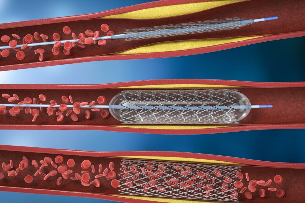 Comment se déroule la pose de stent et à quoi s&rsquo;attendre après l&rsquo;intervention ?