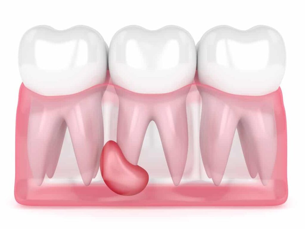 Comment soigner un kyste dentaire naturellement ?