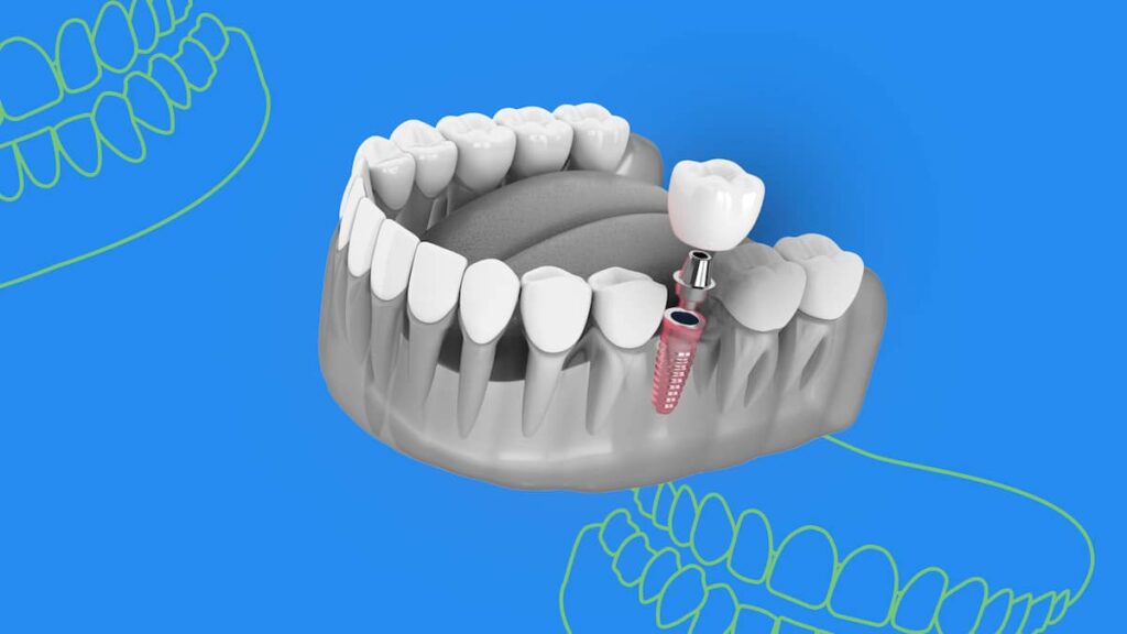 Vue détaillée d'implants dentaires illustrant leur coût global et composants