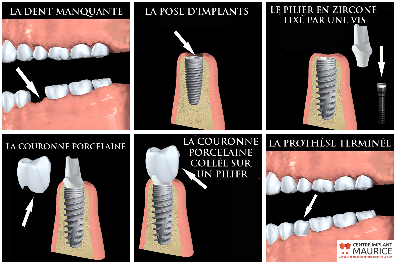 Un implant dentaire en zircone