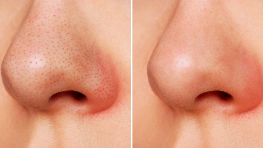 Pourquoi ai-je le nez rouge et comment y remédier ?