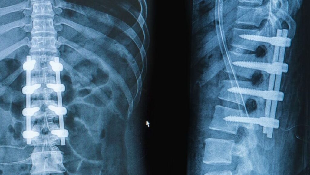 Quels sont les bénéfices et les risques d&rsquo;une arthrodèse lombaire ?